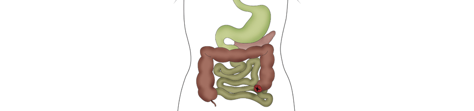 Meer informatie over de verschillen tussen colostomie, ileostomie en urostomie
